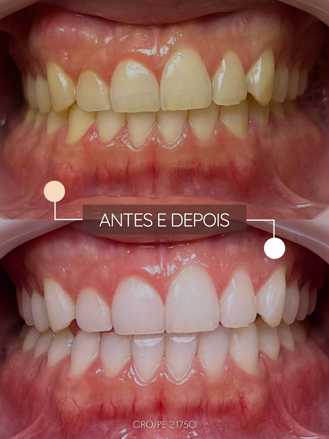 Antes e depois de clareamento dental — paciente da Dra. Letícia Tiemy