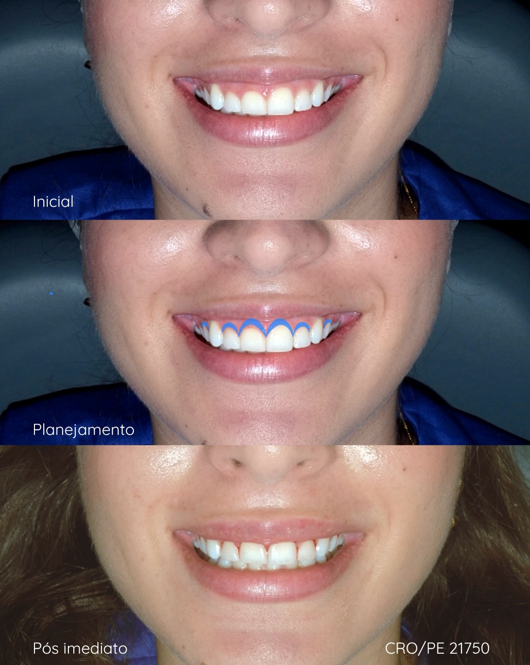 Antes e depois de gengivoplastia — paciente da Dra. Letícia Tiemy